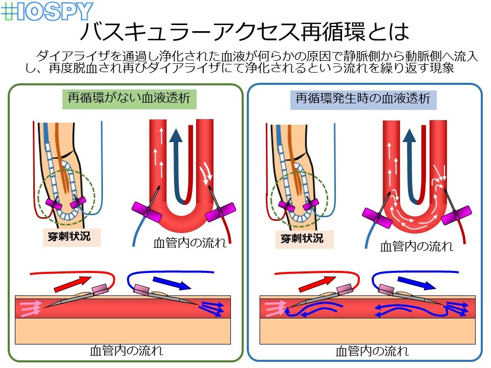 【血液透析　医学専門書】図解 ブラッドアクセス 作り方と使い方 血液透析 医学専門書】図解 ブラッドアクセス 作り方と使い方
